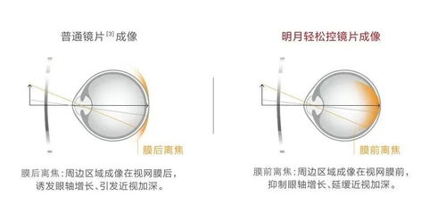 明月镜片推出「轻松控」 专为中国孩子设计的青少年近视管理镜片